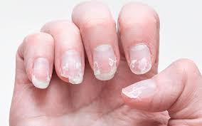 Nail Diseases